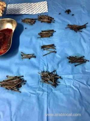250-nails-removed-from-a-mentally-ill-mans-stomach_UAE