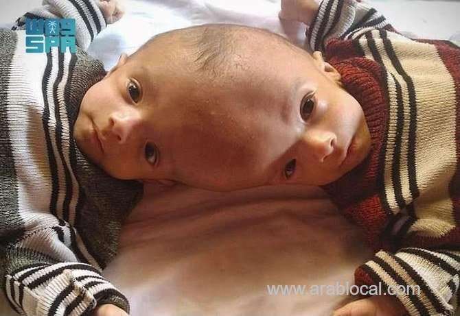 yemeni-conjoined-twins-yousuf-and-yassin-to-fly-to-riyadh-under-king-salmans-orders-for-medical-examination-saudi