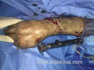 doctors-in-saudi-arabia-reattached-a-worker's-right-hand-after-freak-accident_UAE