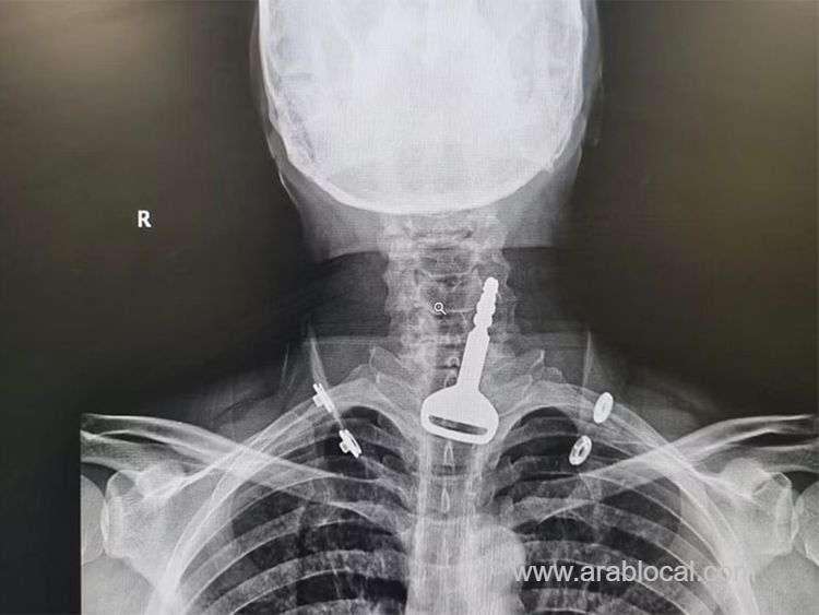 saudi-arabia-successful-endoscopic-operation-saves-man-who-swallowed-car-key-saudi