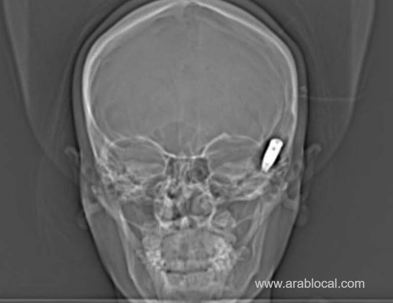 doctors-saved-the-life-of-young-girl-who-had-a-bullet-lodged-in-her-skull-saudi