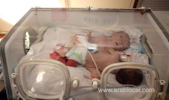 conjoined-twins-from-tanzania-undergo-separation-surgery-in-saudi-arabia-saudi