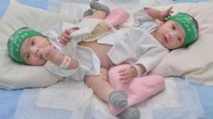 surgery-to-separate-saudi-conjoined-twins-postponed_saudi