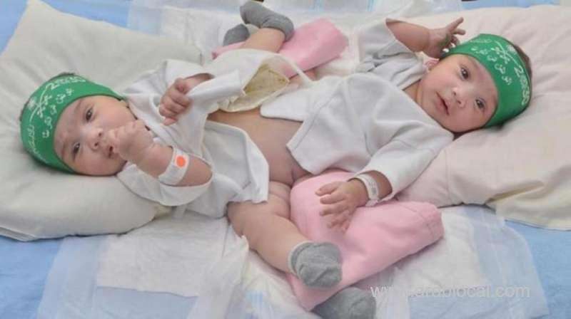 surgery-to-separate-saudi-conjoined-twins-postponed-saudi