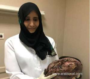 saudi-female-surgeon-leads-operation-to-remove-rare-liver-tumor_UAE