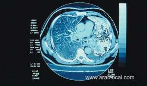 saudi-arabia-steps-up-the-fight-against-cancer_UAE