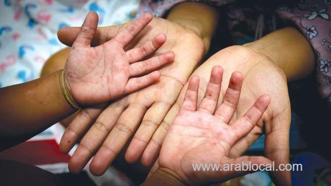 measles-is-making-a-deadly-return-saudi