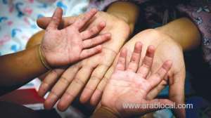 measles-is-making-a-deadly-return_UAE