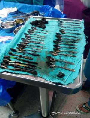 surgeons-in-egypt-extracted-20-spoons-from-patient’s-stomach_UAE