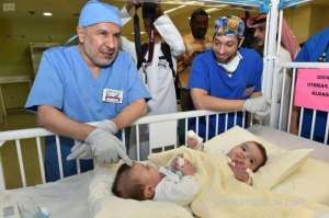 libyan-conjoined-twins-successfully-separated_UAE