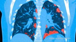 some-patients-who-survived-coronavirus-may-suffer-lasting-lung-damage_saudi