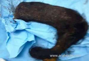 2-kg-of-hair-extacted-from-the-young-womans-stomach-in-taif_UAE