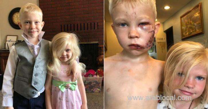 boy-gets-90-stitches-after-saving-little-sister-from-dog-attack-saudi