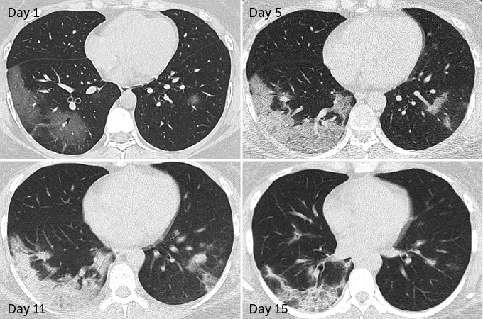 Some Patients Who Survived coronavirus may suffer lasting lung damage